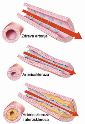 Arterioskleroza i ateroskleroza